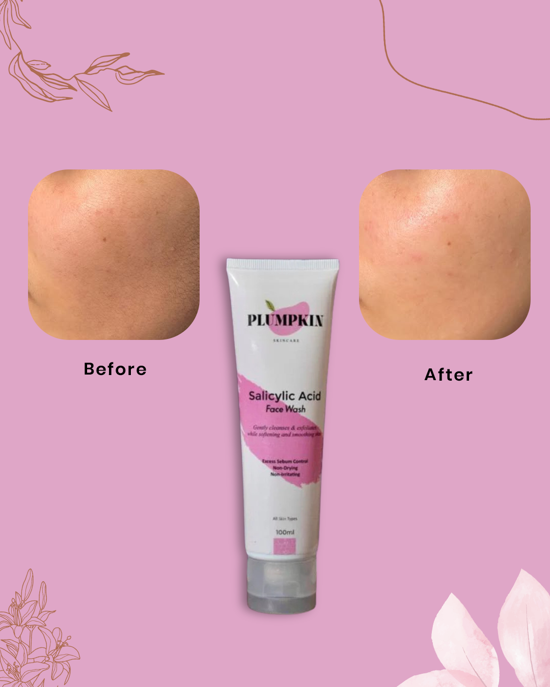 Salicylic Acid Facewash