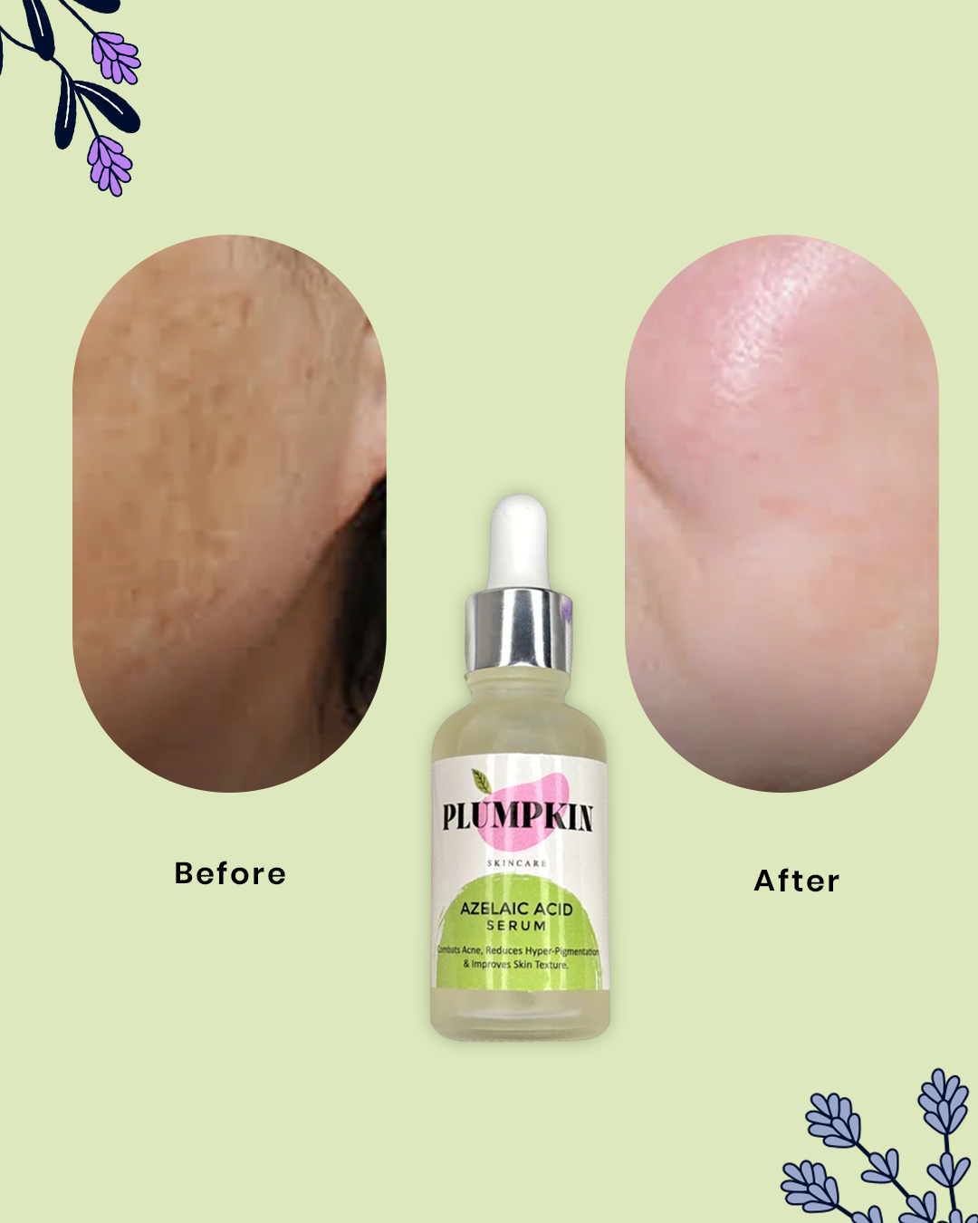 Azelaic Acid Serum